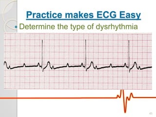Practice makes ECG Easy
 Determine the type of dysrhythmia
43
 