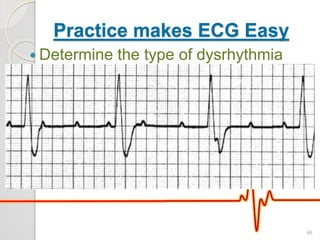 Practice makes ECG Easy
 Determine the type of dysrhythmia
46
 