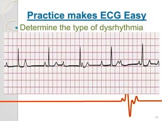 Practice makes ECG Easy
 Determine the type of dysrhythmia
50
 