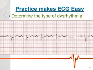 Practice makes ECG Easy
 Determine the type of dysrhythmia
51
 
