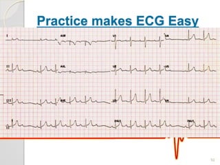 Practice makes ECG Easy
 Determine the type of dysrhythmia
52
 