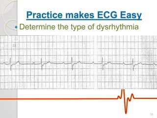 Practice makes ECG Easy
 Determine the type of dysrhythmia
53
 