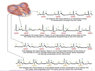 AV Block
5
 
