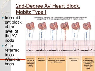 2nd-Degree AV Heart Block,
Mobitz Type I
 Intermitt
ent block
at the
level of
the AV
node
 Also
referred
to as
Wencke
bach
12
 