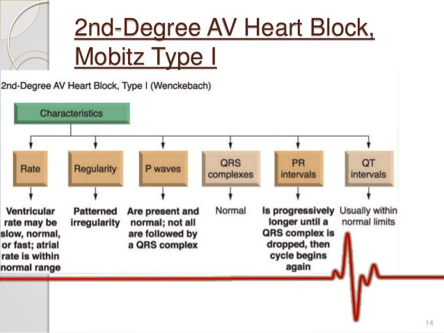 Av Block Ecg Analysis