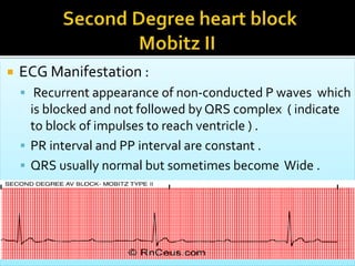  ECG Manifestation :
 Recurrent appearance of non-conducted P waves which
is blocked and not followed by QRS complex ( indicate
to block of impulses to reach ventricle ) .
 PR interval and PP interval are constant .
 QRS usually normal but sometimes become Wide .
 