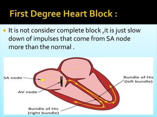  It is not consider complete block ,it is just slow
down of impulses that come from SA node
more than the normal .
 
