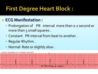  ECG Manifestation :
 Prolongation of PR interval more than 0.2 second or
more than 5 small squares .
 Constant PR interval from beat to another .
 Regular Rhythm .
 Normal Rate or slightly slow .
 