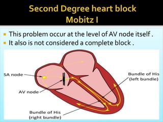  This problem occur at the level of AV node itself .
 It also is not considered a complete block .
 