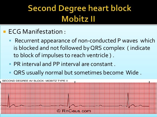 Heart block