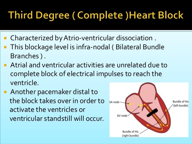 Heart block