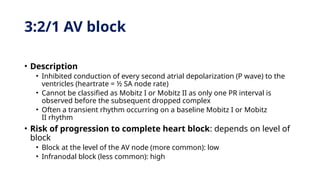 3:2/1 AV block
• Description
• Inhibited conduction of every second atrial depolarization (P wave) to the
ventricles (heartrate = ½ SA node rate)
• Cannot be classified as Mobitz I or Mobitz II as only one PR interval is
observed before the subsequent dropped complex
• Often a transient rhythm occurring on a baseline Mobitz I or Mobitz
II rhythm
• Risk of progression to complete heart block: depends on level of
block
• Block at the level of the AV node (more common): low
• Infranodal block (less common): high
 