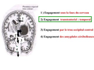 1 ) Engagement sous la faux du cerveau
2) Engagement transtentoriel : temporal
3) Engagement par le trou occipital central
4) Engagement des amygdales cérébelleuses
3
2
1
4
 