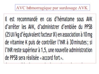 AVC hémorragique par surdosage AVK
 