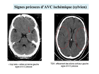 Signes précoces d’AVC ischémique (sylvien)
 