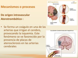 Mecanismos o procesos

De origen intravascular
Aterotrombótico :

• Se forma un coágulo en una de las
  arterias que irrigan el cerebro,
  provocando la isquemia. Este
  fenómeno se ve favorecido por la
  presencia de placas de
  aterosclerosis en las arterias
  cerebrales
 