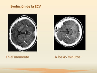 Evolución de la ECV




En el momento           A los 45 minutos
 