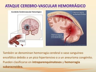 También se denominan hemorragia cerebral o vaso sanguíneo
encefálico debido a un pico hipertensivo o a un aneurisma congénito.
Pueden clasificarse en intraparenquimatosos y hemorragia
subaracnoidea.
 