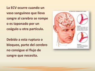 La ECV ocurre cuando un
vaso sanguíneo que lleva
sangre al cerebro se rompe
o es taponado por un
coágulo u otra partícula.

Debido a esta ruptura o
bloqueo, parte del cerebro
no consigue el flujo de
sangre que necesita.
 