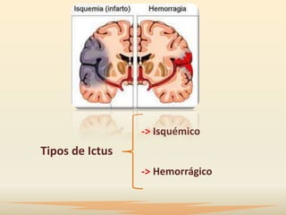 -> Isquémico
Tipos de Ictus
                 -> Hemorrágico
 