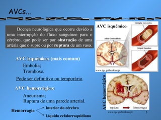 AVCs... www.igc.gulbenkian.pt www.igc.gulbenkian.pt Doença neurológica que ocorre devido a uma interrupção do fluxo sanguíneo para o cérebro, que pode ser por  obstrução  de uma artéria que o supre ou por  ruptura  de um vaso. AVC isquémico AVC hemorrágico AVC isquémico:  (mais comum) Embolia; Trombose. AVC hemorrágico: Aneurisma; Pode ser definitivo ou temporário. Ruptura de uma parede arterial. Hemorragia Interior do cérebro Líquido cefalorraquidiano 
