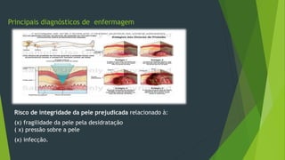 Principais diagnósticos de enfermagem
Risco de integridade da pele prejudicada relacionado à:
(x) fragilidade da pele pela desidratação
( x) pressão sobre a pele
(x) infecção.
 