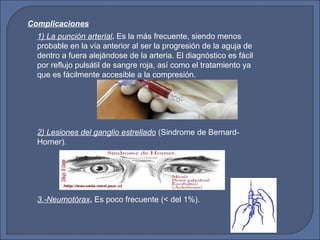 1) La punción arterial. Es la más frecuente, siendo menos
probable en la vía anterior al ser la progresión de la aguja de
dentro a fuera alejándose de la arteria. El diagnóstico es fácil
por reflujo pulsátil de sangre roja, así como el tratamiento ya
que es fácilmente accesible a la compresión.
2) Lesiones del ganglio estrellado (Sindrome de Bernard-
Horner).
3.-Neumotórax. Es poco frecuente (< del 1%).
Complicaciones
 