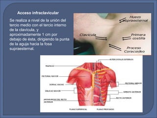 Se realiza a nivel de la unión del
tercio medio con el tercio interno
de la clavícula, y
aproximadamente 1 cm por
debajo de ésta, dirigiendo la punta
de la aguja hacia la fosa
supraesternal.
Acceso infraclavicular
 