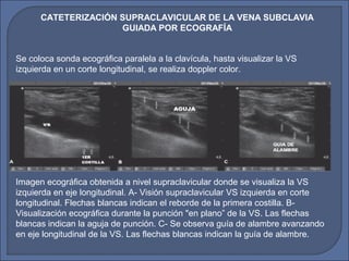 Imagen ecográfica obtenida a nivel supraclavicular donde se visualiza la VS
izquierda en eje longitudinal. A- Visión supraclavicular VS izquierda en corte
longitudinal. Flechas blancas indican el reborde de la primera costilla. B-
Visualización ecográfica durante la punción "en plano” de la VS. Las flechas
blancas indican la aguja de punción. C- Se observa guía de alambre avanzando
en eje longitudinal de la VS. Las flechas blancas indican la guía de alambre.
Se coloca sonda ecográfica paralela a la clavícula, hasta visualizar la VS
izquierda en un corte longitudinal, se realiza doppler color.
CATETERIZACIÓN SUPRACLAVICULAR DE LA VENA SUBCLAVIA
GUIADA POR ECOGRAFÍA
 