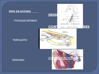 TIPO DE ACCESO
•SUBCLAVIO
•FEMORAL
•YUGULAR INTERNO
INDICACIÓNES
CONTRAINDICACIÓNES
TÉCNICAS
COMPLICACIÓNES
 