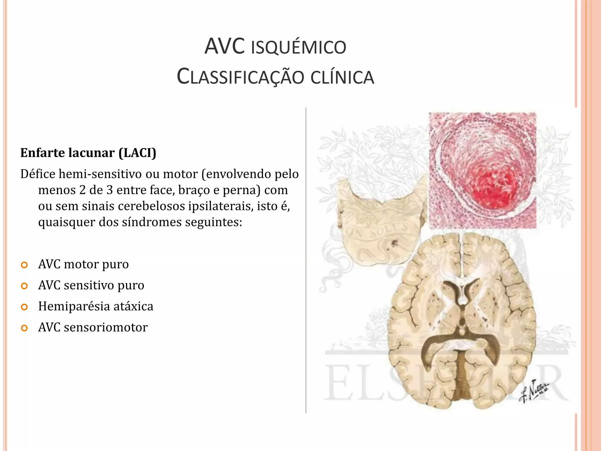 AVC ISQUÉMICO
CLASSIFICAÇÃO CLÍNICA
Enfarte lacunar (LACI)
Défice hemi-sensitivo ou motor (envolvendo pelo
menos 2 de 3 entre face, braço e perna) com
ou sem sinais cerebelosos ipsilaterais, isto é,
quaisquer dos síndromes seguintes:
 AVC motor puro
 AVC sensitivo puro
 Hemiparésia atáxica
 AVC sensoriomotor
 