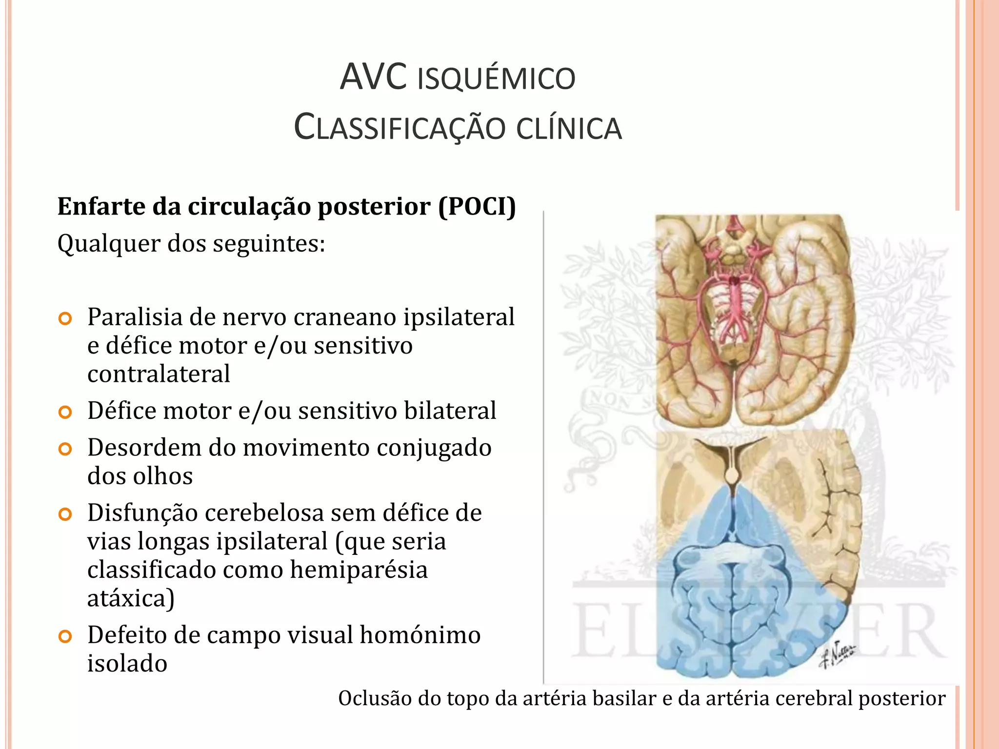 AVC ISQUÉMICO
CLASSIFICAÇÃO CLÍNICA
Enfarte da circulação posterior (POCI)
Qualquer dos seguintes:
 Paralisia de nervo craneano ipsilateral
e défice motor e/ou sensitivo
contralateral
 Défice motor e/ou sensitivo bilateral
 Desordem do movimento conjugado
dos olhos
 Disfunção cerebelosa sem défice de
vias longas ipsilateral (que seria
classificado como hemiparésia
atáxica)
 Defeito de campo visual homónimo
isolado
Oclusão do topo da artéria basilar e da artéria cerebral posterior
 
