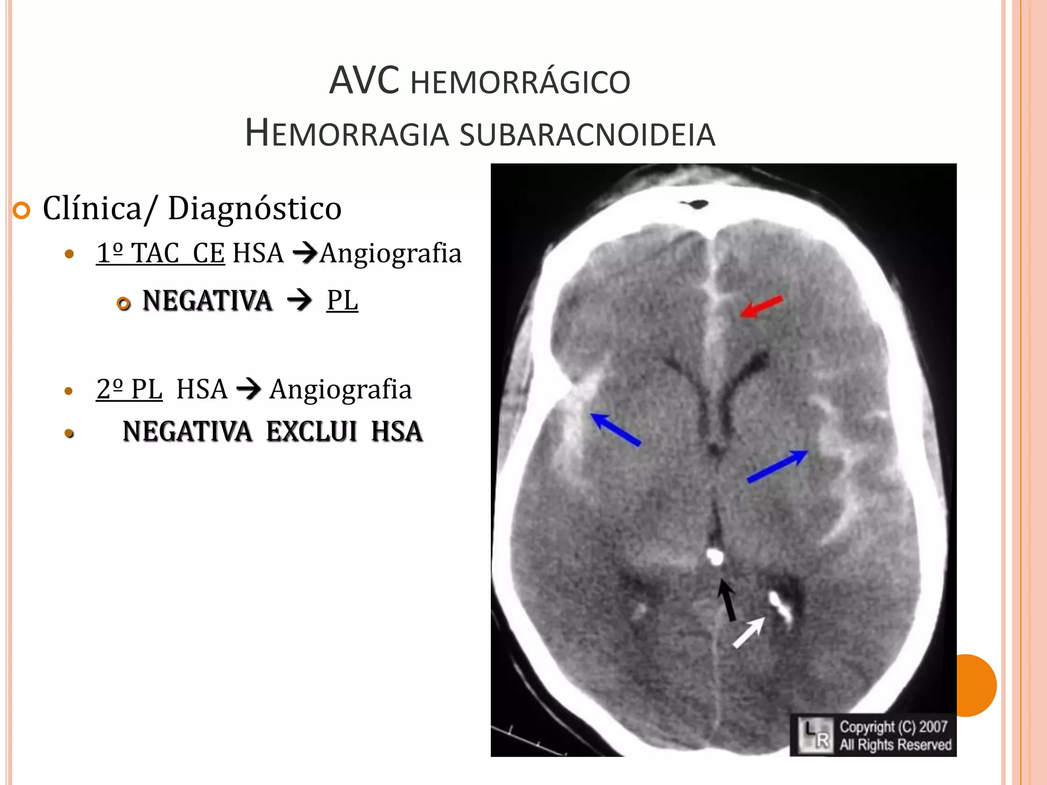 AVC HEMORRÁGICO
HEMORRAGIA SUBARACNOIDEIA
 Clínica/ Diagnóstico
 1º TAC CE HSA Angiografia
 NEGATIVA  PL
 2º PL HSA  Angiografia
 NEGATIVA EXCLUI HSA
 