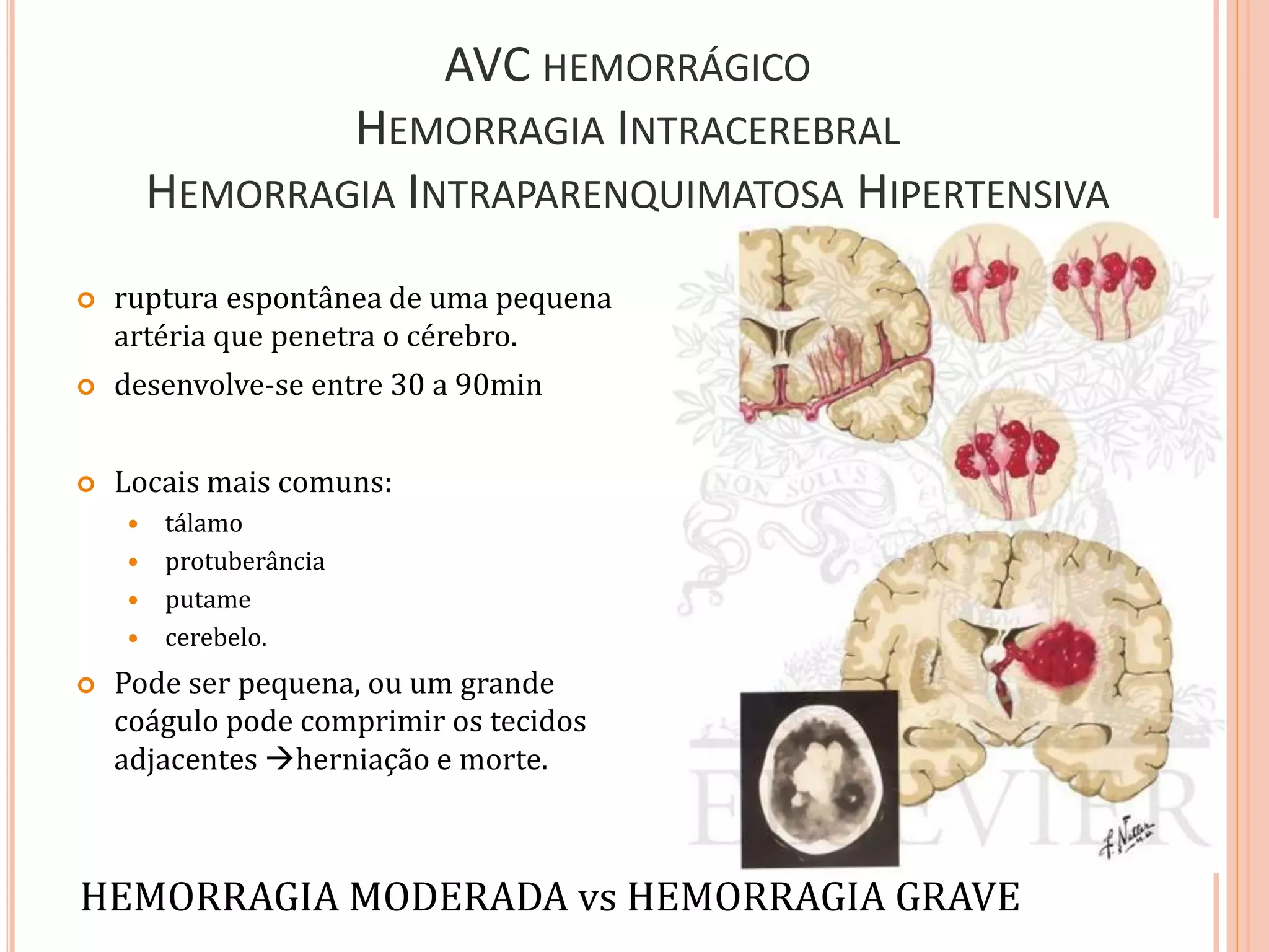 AVC HEMORRÁGICO
HEMORRAGIA INTRACEREBRAL
HEMORRAGIA INTRAPARENQUIMATOSA HIPERTENSIVA
 ruptura espontânea de uma pequena
artéria que penetra o cérebro.
 desenvolve-se entre 30 a 90min
 Locais mais comuns:
 tálamo
 protuberância
 putame
 cerebelo.
 Pode ser pequena, ou um grande
coágulo pode comprimir os tecidos
adjacentes herniação e morte.
HEMORRAGIA MODERADA vs HEMORRAGIA GRAVE
 