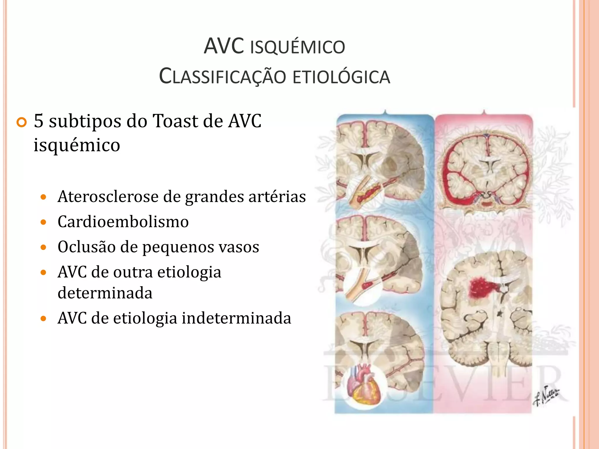 AVC ISQUÉMICO
CLASSIFICAÇÃO ETIOLÓGICA
 5 subtipos do Toast de AVC
isquémico
 Aterosclerose de grandes artérias
 Cardioembolismo
 Oclusão de pequenos vasos
 AVC de outra etiologia
determinada
 AVC de etiologia indeterminada
 