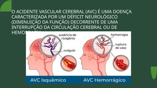 O ACIDENTE VASCULAR CEREBRAL (AVC) É UMA DOENÇA
CARACTERIZADA POR UM DÉFICIT NEUROLÓGICO
(DIMINUIÇÃO DA FUNÇÃO) DECORRENTE DE UMA
INTERRUPÇÃO DA CIRCULAÇÃO CEREBRAL OU DE
HEMORRAGIA.
 