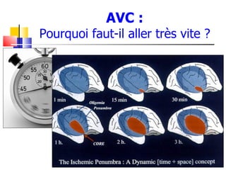 AVC :
Pourquoi faut-il aller très vite ?
 