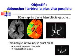 Objectif :
déboucher l’artère le plus vite possible

         90mn après d’une hémiplégie gauche …




Thrombolyse intraveineuse avant 4h30 :
   artère à nouveau circulante
   récupération rapide
 