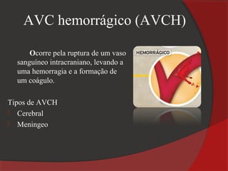 AVC hemorrágico (AVCH)

      Ocorre pela ruptura de um vaso
  sanguíneo intracraniano, levando a
  uma hemorragia e a formação de
  um coágulo.

Tipos de AVCH
 Cerebral
 Meningeo
 