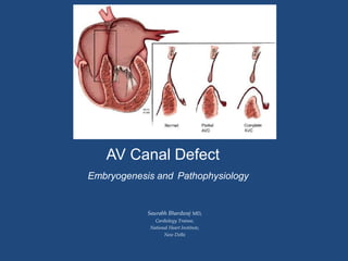 AV Canal Defect
Embryogenesis and Pathophysiology
Saurabh Bhardwaj MD,
Cardiology Trainee,
National Heart Institute,
New Delhi
 