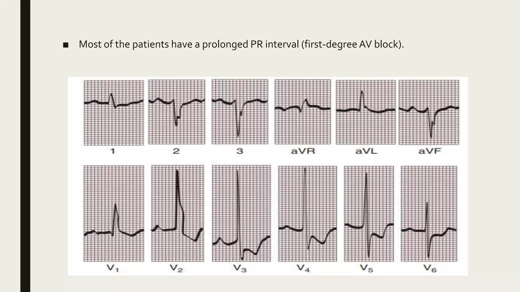 av-canal-defect-pptx