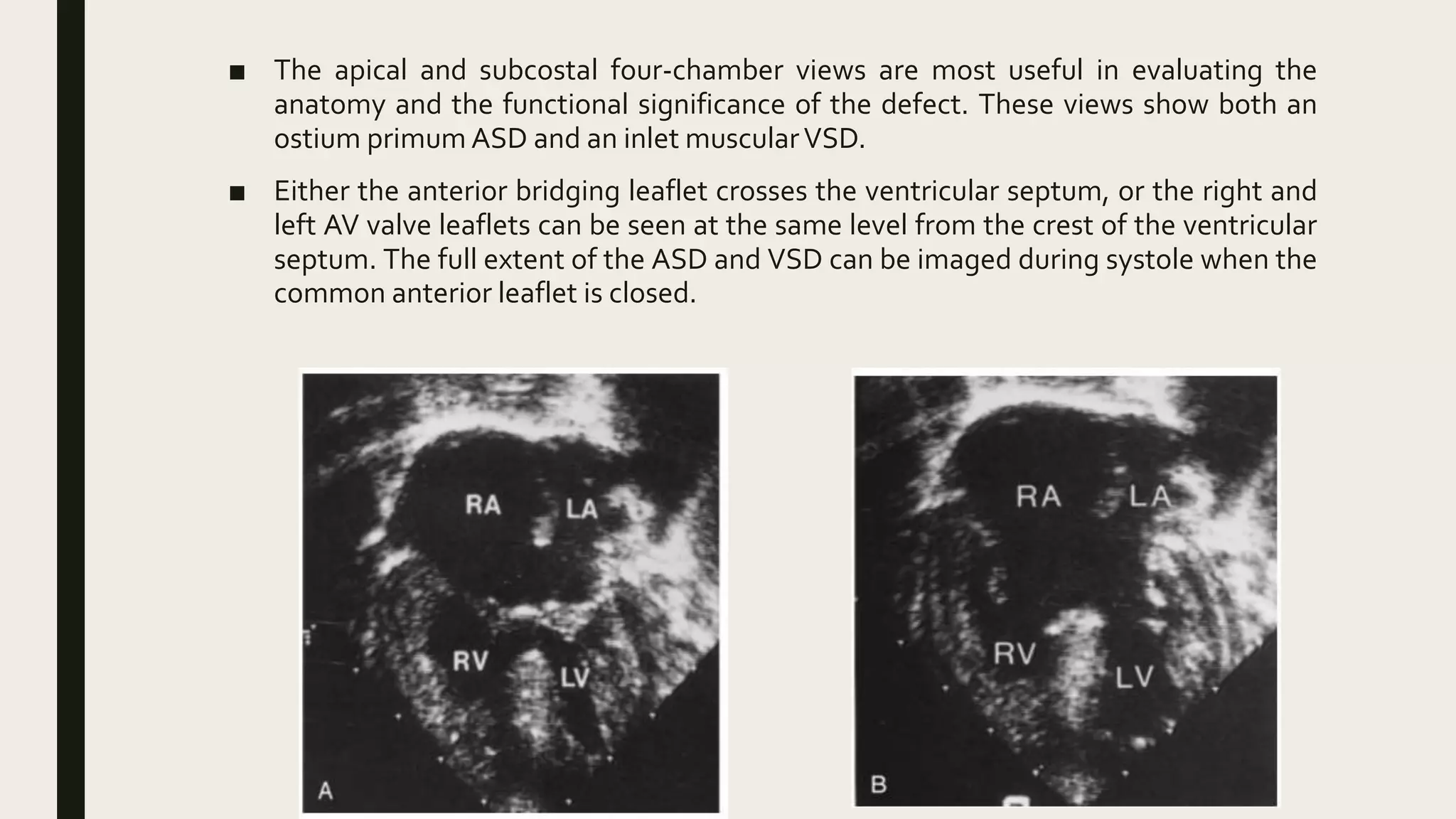 Av canal defect | PPTX