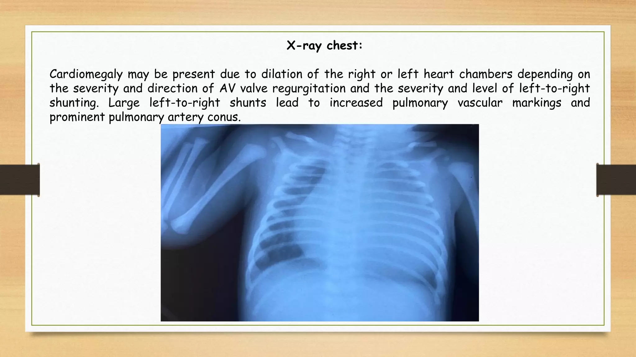 X-ray chest:
Cardiomegaly may be present due to dilation of the right or left heart chambers depending on
the severity and direction of AV valve regurgitation and the severity and level of left-to-right
shunting. Large left-to-right shunts lead to increased pulmonary vascular markings and
prominent pulmonary artery conus.
 