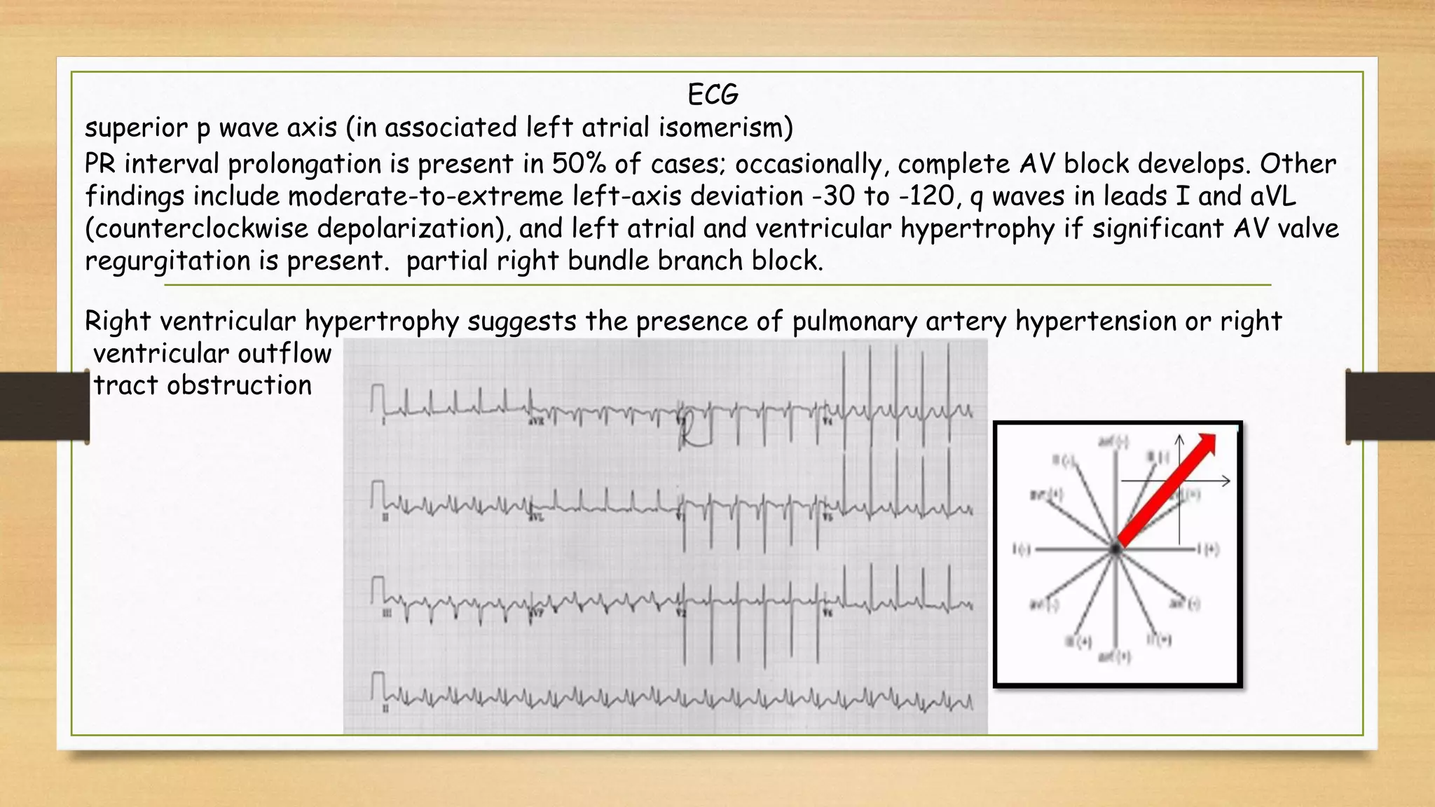 ECG
superior p wave axis (in associated left atrial isomerism)
PR interval prolongation is present in 50% of cases; occasionally, complete AV block develops. Other
findings include moderate-to-extreme left-axis deviation -30 to -120, q waves in leads I and aVL
(counterclockwise depolarization), and left atrial and ventricular hypertrophy if significant AV valve
regurgitation is present. partial right bundle branch block.
Right ventricular hypertrophy suggests the presence of pulmonary artery hypertension or right
ventricular outflow
tract obstruction
 