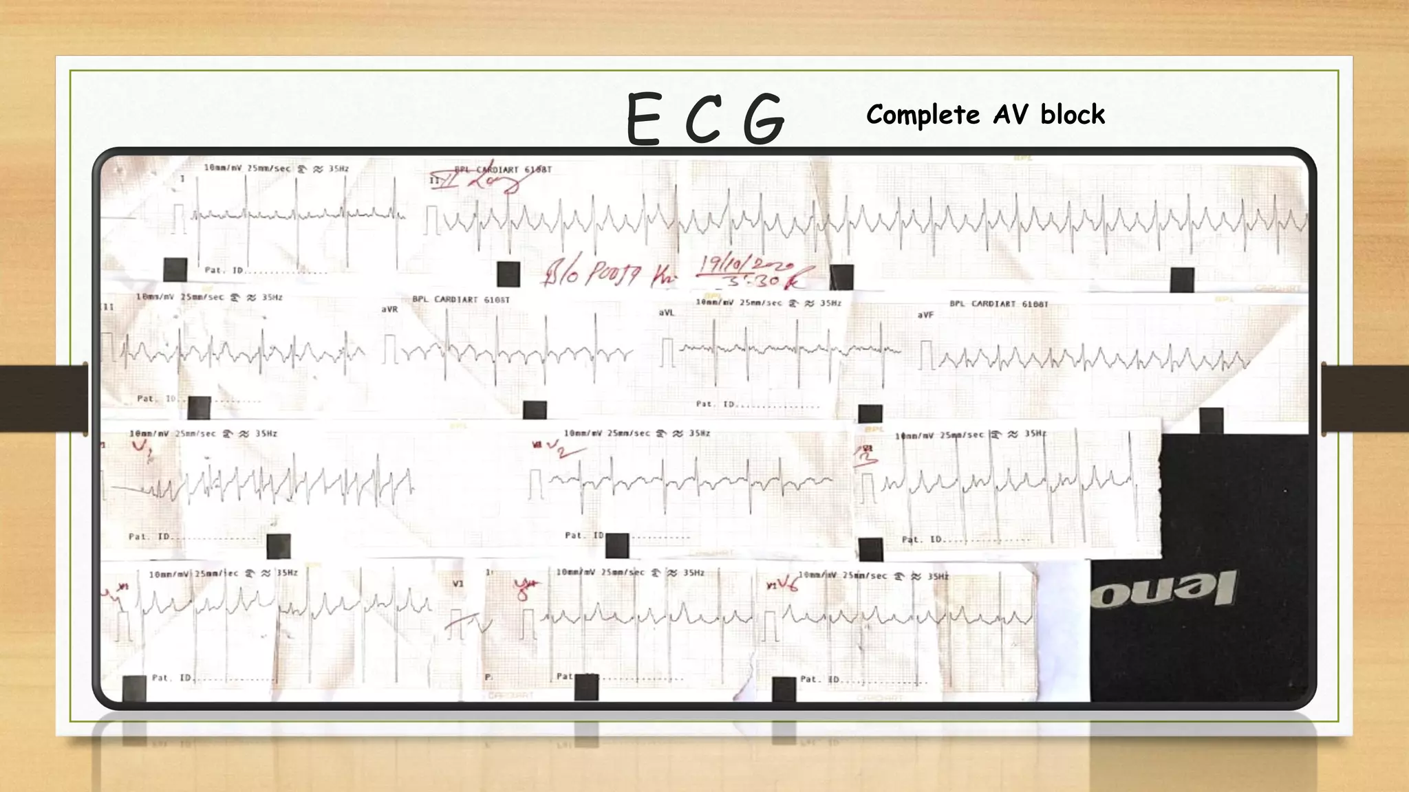 E C G Complete AV block
 