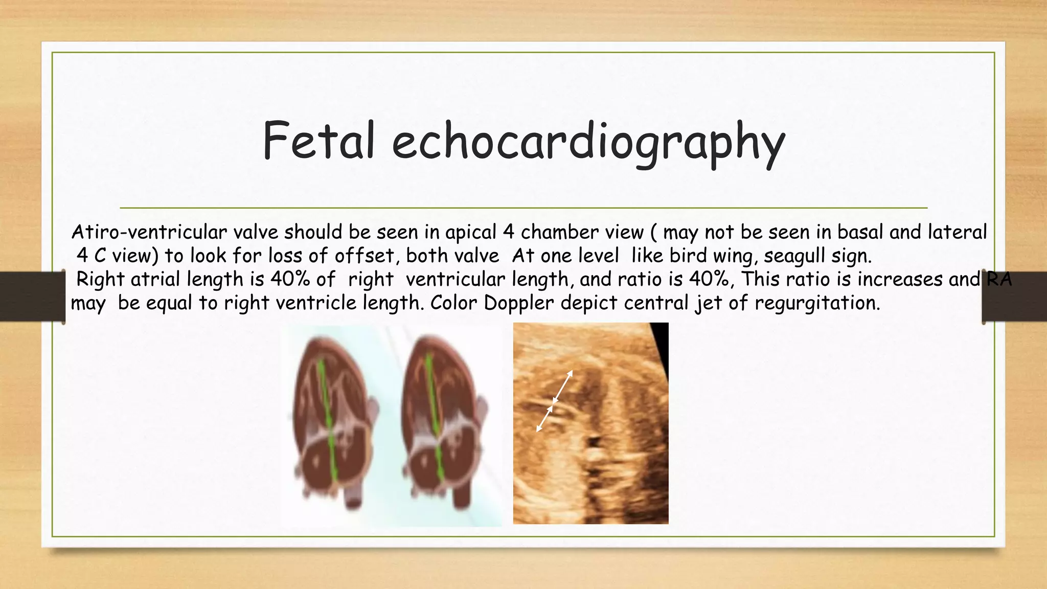 Fetal echocardiography
Atiro-ventricular valve should be seen in apical 4 chamber view ( may not be seen in basal and lateral
4 C view) to look for loss of offset, both valve At one level like bird wing, seagull sign.
Right atrial length is 40% of right ventricular length, and ratio is 40%, This ratio is increases and RA
may be equal to right ventricle length. Color Doppler depict central jet of regurgitation.
 