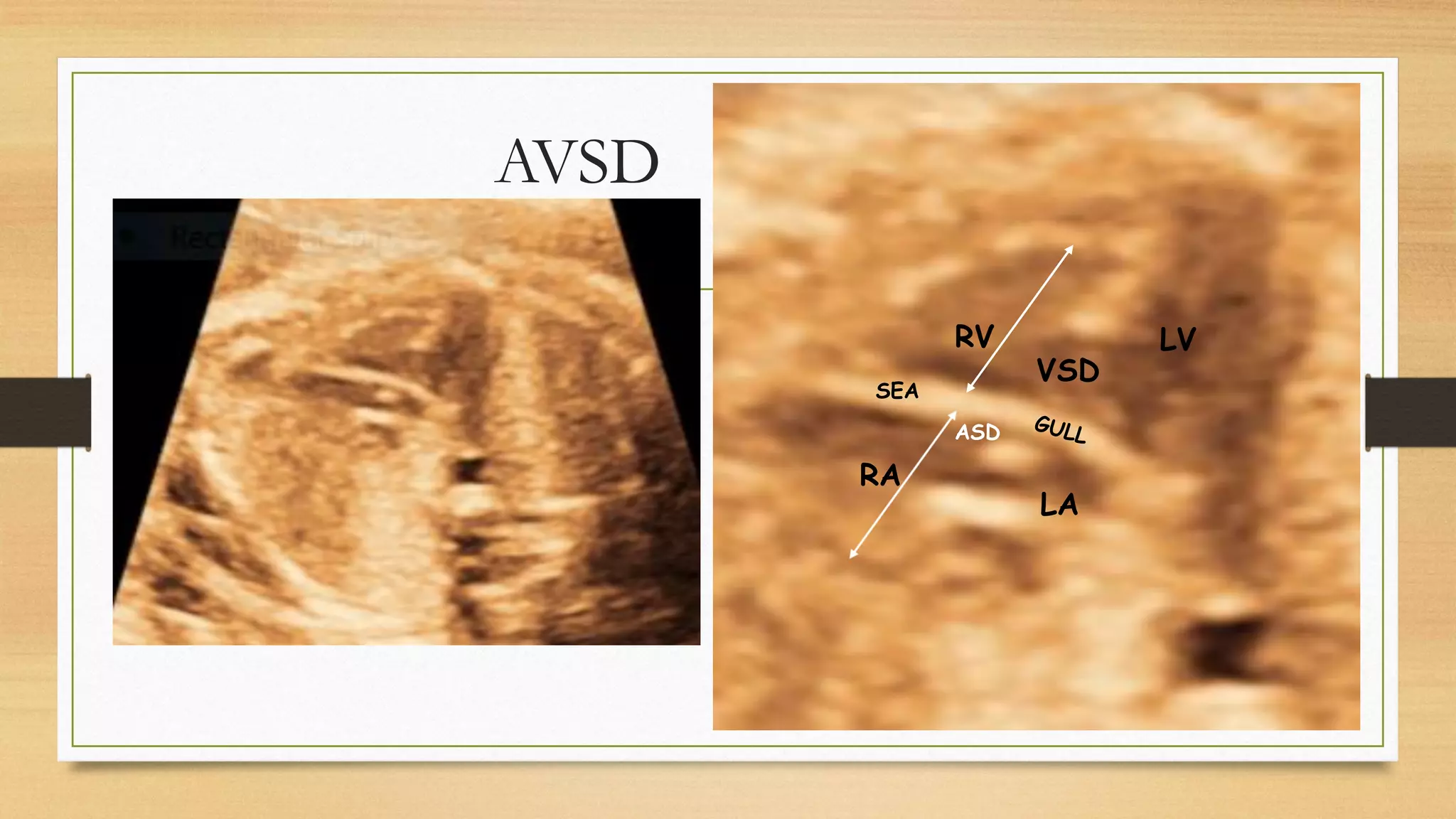 AVSD
RV
RA
LA
LV
VSD
ASD
SEA
 