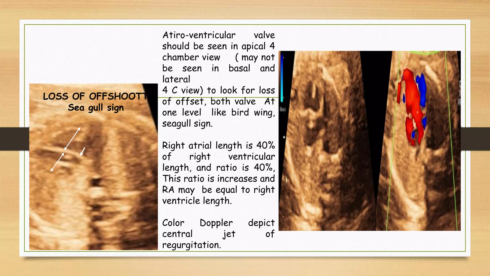 Atiro-ventricular valve
should be seen in apical 4
chamber view ( may not
be seen in basal and
lateral
4 C view) to look for loss
of offset, both valve At
one level like bird wing,
seagull sign.
Right atrial length is 40%
of right ventricular
length, and ratio is 40%,
This ratio is increases and
RA may be equal to right
ventricle length.
Color Doppler depict
central jet of
regurgitation.
LOSS OF OFFSHOOTT
Sea gull sign
 