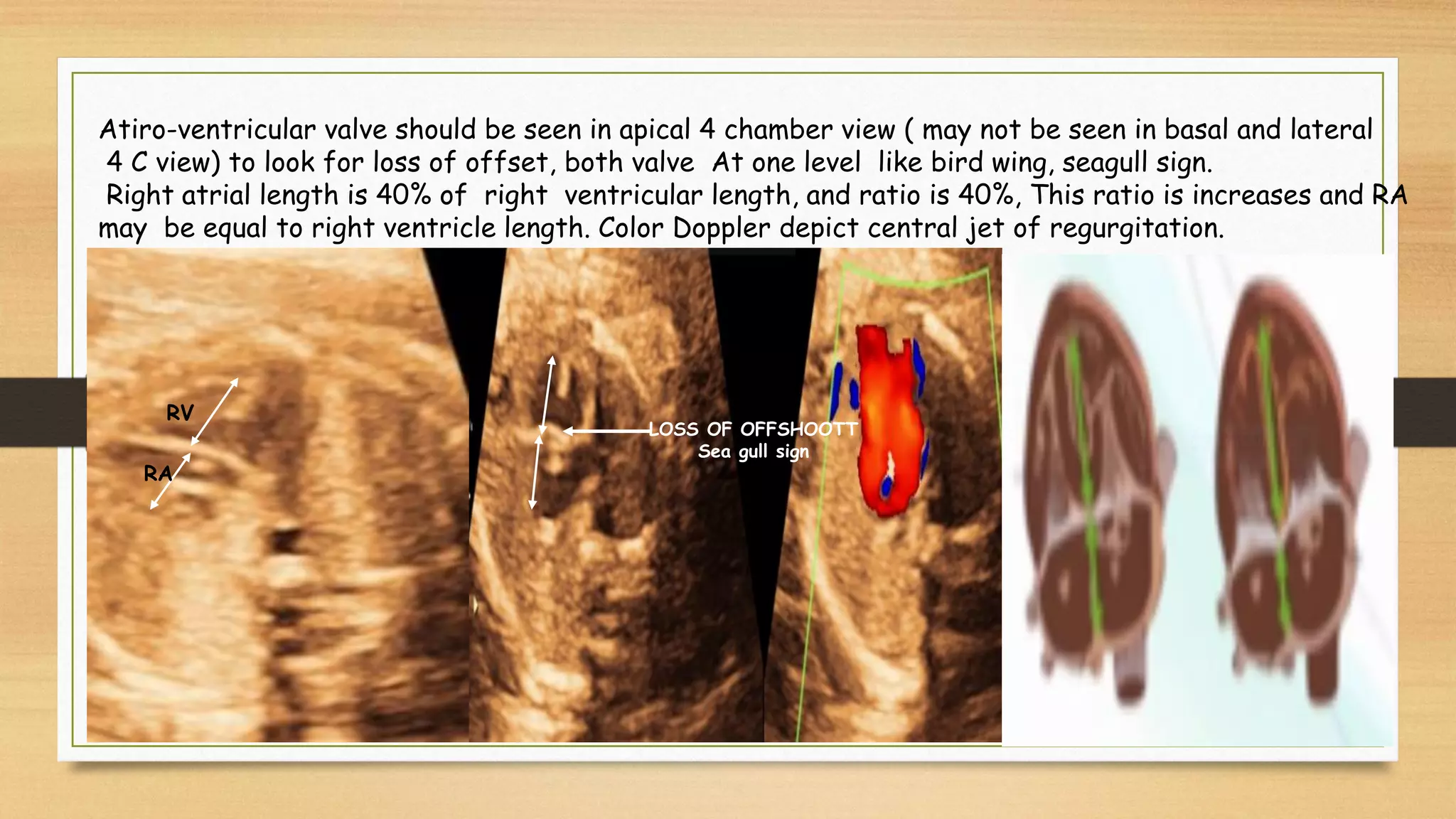 Atiro-ventricular valve should be seen in apical 4 chamber view ( may not be seen in basal and lateral
4 C view) to look for loss of offset, both valve At one level like bird wing, seagull sign.
Right atrial length is 40% of right ventricular length, and ratio is 40%, This ratio is increases and RA
may be equal to right ventricle length. Color Doppler depict central jet of regurgitation.
LOSS OF OFFSHOOTT
Sea gull sign
RV
RA
 