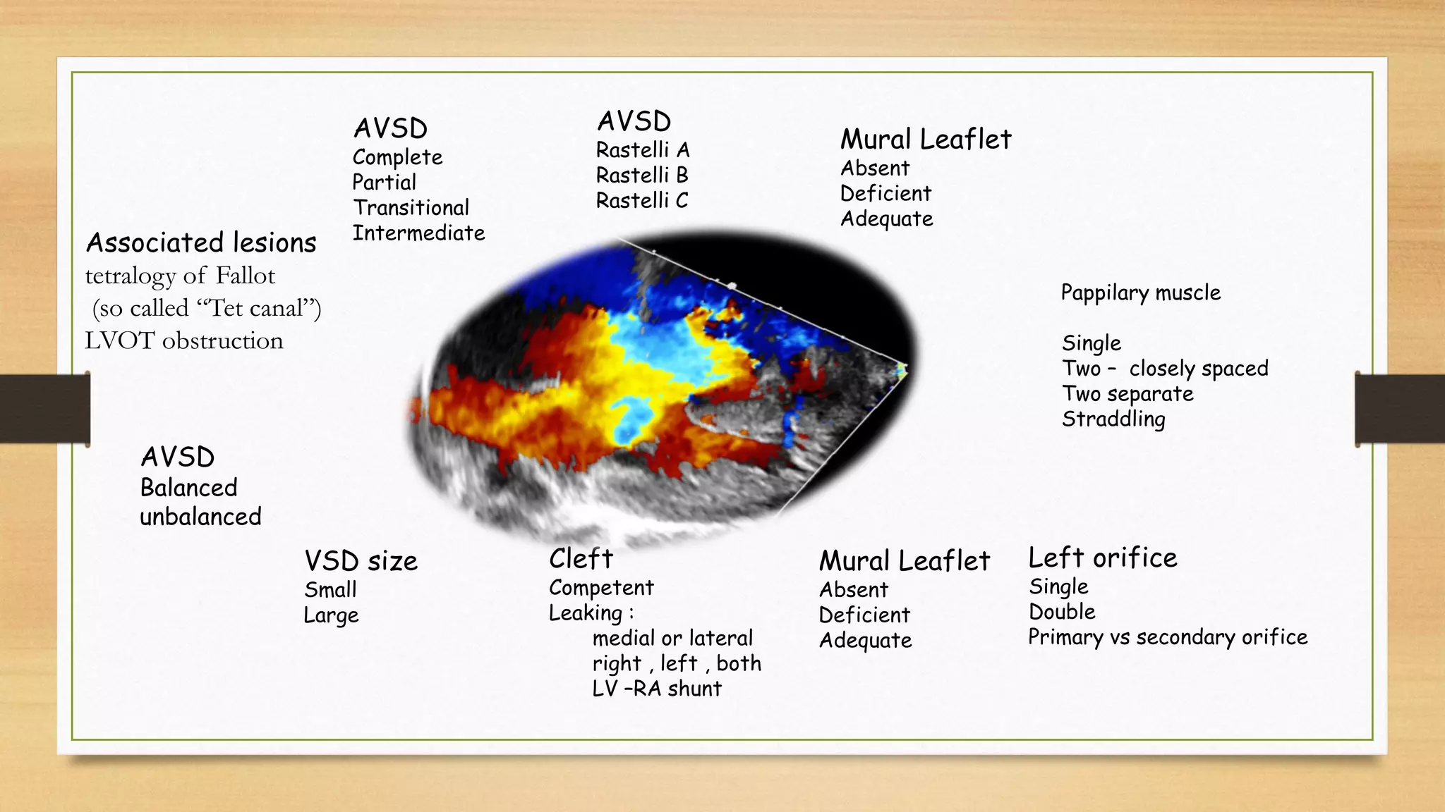 AVSD
Complete
Partial
Transitional
Intermediate
AVSD
Rastelli A
Rastelli B
Rastelli C
Mural Leaflet
Absent
Deficient
Adequate
Pappilary muscle
Single
Two – closely spaced
Two separate
Straddling
Left orifice
Single
Double
Primary vs secondary orifice
Mural Leaflet
Absent
Deficient
Adequate
Cleft
Competent
Leaking :
medial or lateral
right , left , both
LV –RA shunt
VSD size
Small
Large
AVSD
Balanced
unbalanced
Associated lesions
tetralogy of Fallot
(so called “Tet canal”)
LVOT obstruction
 